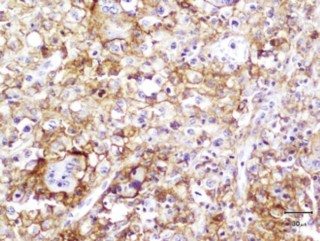 Figure 7. Immunostaining showing positive CD18. Histiocytic sarcoma with large numbers of cells with cytoplasmic immunopositivity for CD18.