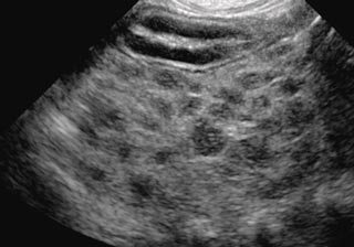 Figure 4. Ultrasound showing “honeycomb” appearance of the liver.