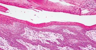 Figure 5. Histopathology of a skin biopsy, showing the red, white and blue pattern.