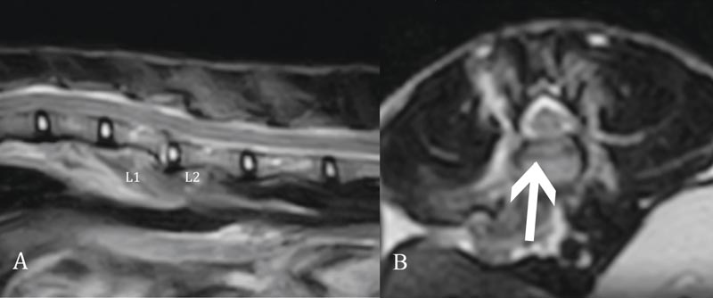 Figure 1. (A) Sagittal T2-weighted image. (B) Transverse T2-weighted image. Spinal fracture and luxation at L1 to L2. L1 caudal end plate fracture (arrow) not associated with marked compression of the spinal cord.