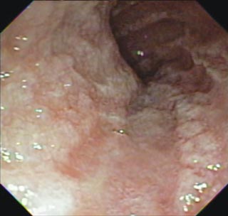 Figure 1. Endoscopic image of the small intestine showing a nodular, erythematous mucosal surface with lacteal dilation.