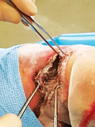 Figure 3. Severely contaminated wound on the plantar aspect of the pastern. Note the “grey” inground appearance of the wound.