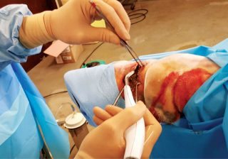 Figure 4. Appearance of the same wound in Figure 3 during debridement with a hydrosurgical wound debridement system. The wound was sutured post-debridement and placed in a fiberglass cast, resulting in good primary intention healing.