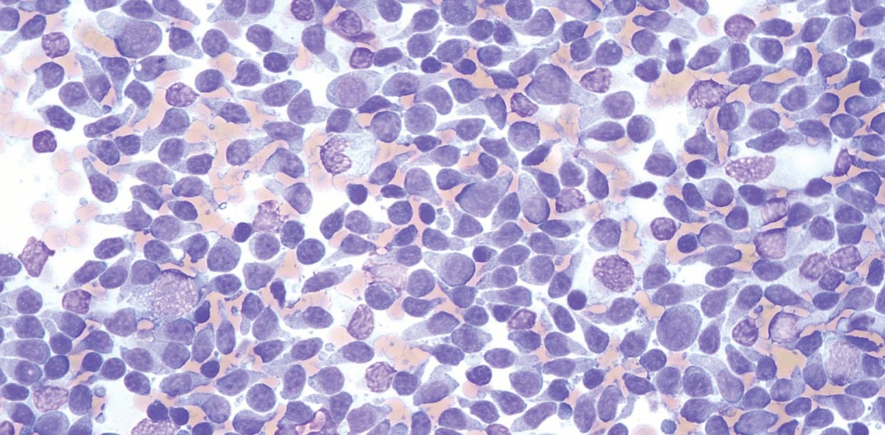 Figure 1b. Flow cytometry is most appropriate in aspirates where there is a prominent population of atypical cells, including in aspirates labelled small cell lymphoma.