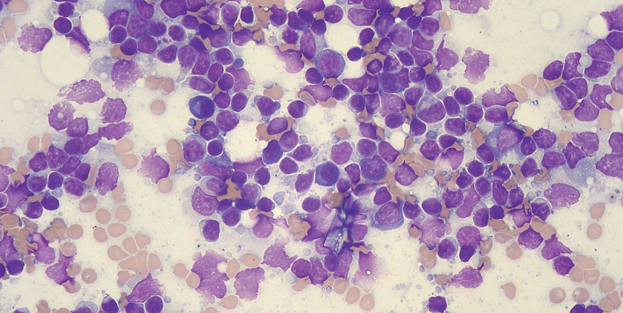 Figure 1c. Flow cytometry is most appropriate in aspirates where there is a prominent population of atypical cells. The lymphoid population is mixed in the aspirate above.