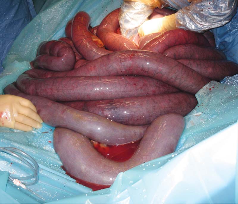 Figure 5. A small intestinal strangulation, demonstrating the multiple loops of distended small intestine, which may be palpable on rectal exam.