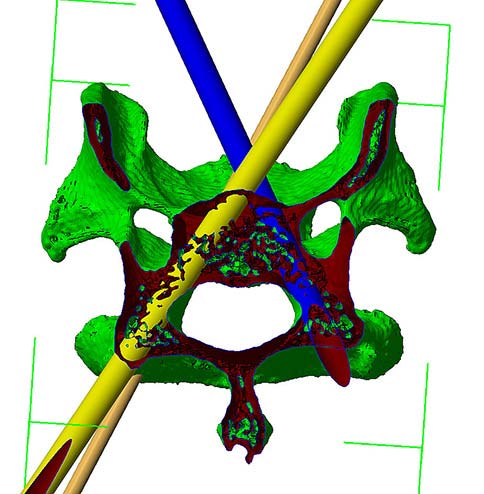 Figure 1. Computer-aided design transverse virtual image of C6 with three colour cylinders representing the planned screw trajectories.