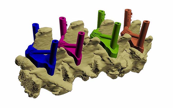 Figure 3. Computer-aided design sagittal oblique virtual image of four vertebrae (T12 to L2) with four drill guides in place dorsally.