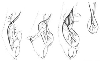 Figure 3. Technique for recruitment of microneurovascular free pad for autogenous transplantation from hindlimb to forelimb. Image: Basher et al, 1990.