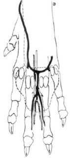 Figure 4. Choices of recipient arteries, vein and nerve for receipt of the pad harvested in the manner shown in Figure 3. Image: Basher et al, 1990.