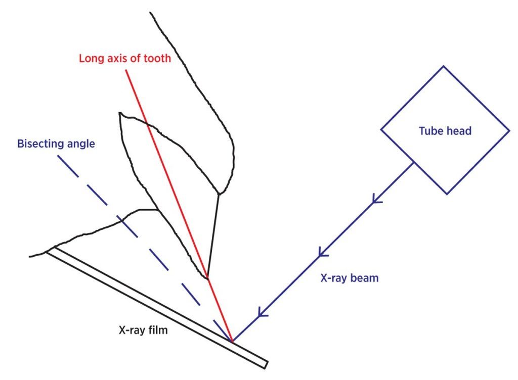 Bisecting angle technique.