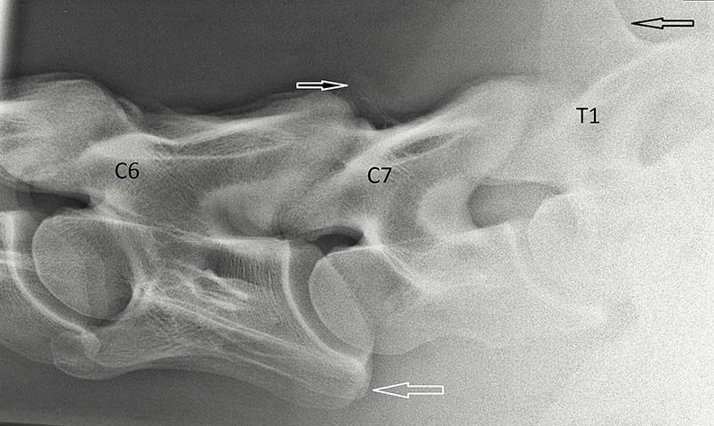 Figure 1. Lateral-lateral radiograph of the 6th and 7th cervical (C6 and C7) and 1st thoracic (T1) vertebrae. There is a small, but well-defined, triangular-shaped spinous process on C7 (black and white arrow). The spinous process of T1 is tall and pronounced (black arrow; its proximal aspect is not included in the image). The ventral processes are located on C6 (white arrow), indicating no anomaly.