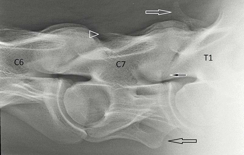 Figure 2. Lateral-lateral radiograph of the caudal aspect of the cervical spine and the 1st thoracic vertebra (T1). There is small spinous process on the 7th cervical vertebra (C7; arrowhead). The ventral processes of the 6th cervical vertebra (C6) are transposed to C7 (black arrow). The spinous process of T1 is short and squat. There is mild enlargement of the articular process joints between C7 and T1 (black and white arrow).