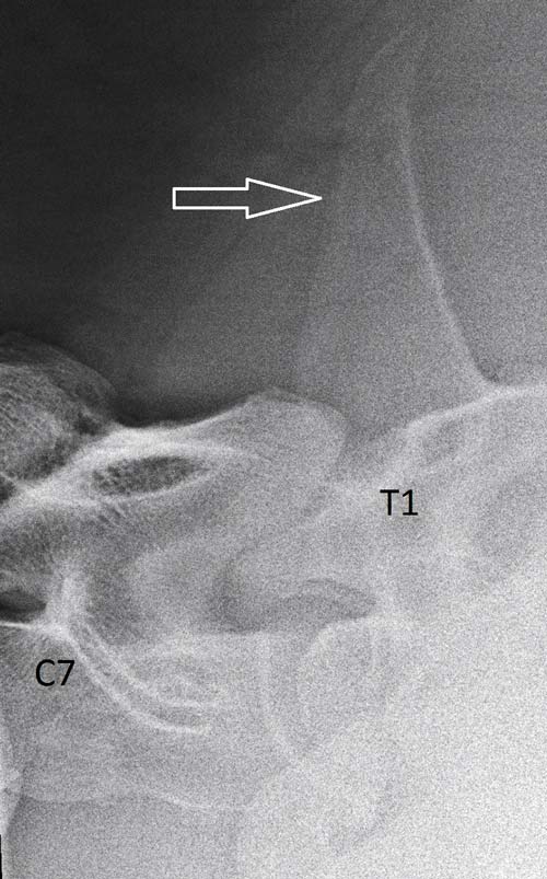 Figure 3. Lateral-lateral radiograph of the 7th cervical (C7) and 1st thoracic (T1) vertebra. The spinous process of T1 is high and pronounced (arrow).