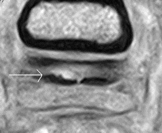 Figure 5. Transverse T1-weighted gradient echo low-field magnetic resonance images obtained at the level of the proximal aspect of the navicular bursa. A marked irregularity exists of the dorsal border of the deep digital flexor tendon (arrow), which was associated with soft tissue proliferation in the navicular bursa.