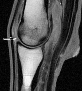 Figure 6. Sagittal high-field T1-weighted gradient echo magnetic resonance image of a fetlock region. The articular cartilage appears as a uniform layer of intermediate signal intensity on the distal aspect of the third metatarsal bone (arrow). Note, it is impossible to differentiate between the articular cartilage of the third metatarsal bone and proximal phalanx where the articular surfaces are juxtaposed to each other.
