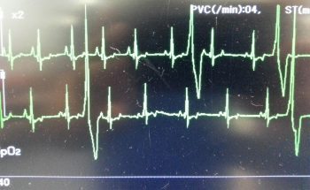 arrhythmia