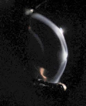 Figure 2. Slit lamp photography of the cornea – a cross-sectional view. Note the central indentation indicating a deep stromal defect with associated infiltrate of the deep corneal stroma.