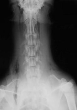 Figure 2. Conventional radiograph, ventrodorsal cervical view showing free gas within the fascial planes and also within the right axilla.