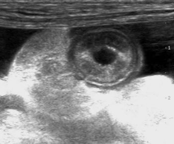 Figure 1. An ultrasonographic image of the canine small intestine showing hyperechoic mucosal striations. This finding may be associated with lacteal dilation.
