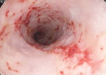 Figure 3. An endoscopic view of the canine duodenum showing multiple areas of ulceration. Biopsy showed a moderate eosinophilic enteritis.