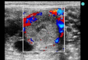 Figure 2. Colour doppler ultrasonographic image showing blood flow in an active corpus luteum. IMAGE: James Crabtree/Equine Reproductive Services.