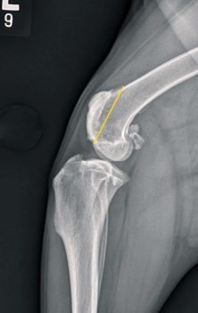 Figure 2. Mediolateral radiograph of the stifle of an eight-year-old golden retriever suffering from grade three medial patellar luxation demonstrating the “ridgespan” measurement.