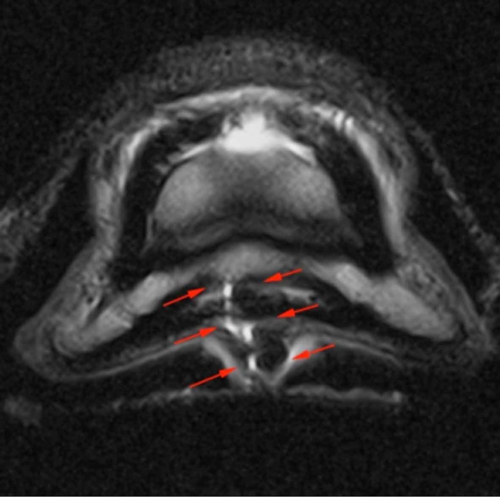 Figure 4. T2-weighted, fast spin echo high-resolution transverse image from an MRI to investigate a suspected solar puncture. The red arrows indicate an extensive tract in the solar soft tissues extending through the insertion of the deep digital flexor tendon. Note the foot has been wrapped with a damp bandage to aid in MRI assessment.