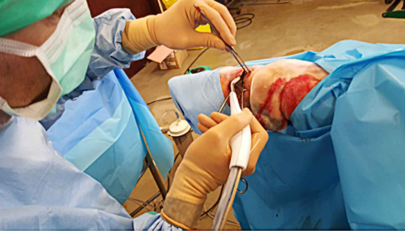Figure 7. Use of a Versajet hydrosurgery scalpel to debride a grossly contaminated wound on the plantar pastern.