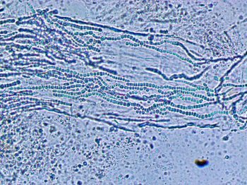 Figure 1. Chains of fungal arthrospores consistent with a diagnosis of dermatophytosis.