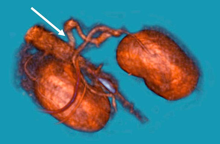 Figure 2. A 3D reconstruction of a contrast CT scan. The arrow shows portocaval shunt.