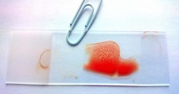 Figure 2. A positive saline autoagglutination test, demonstrating macroscopic red blood cell agglutination.