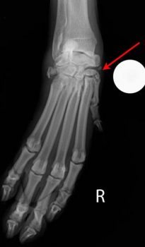 Figure 4. Valgus stressed dorsopalmar projection showing intra-articular spaces appear wider than expected (arrow).