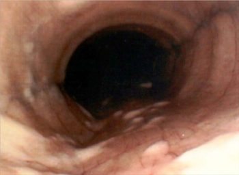 Figure 2b. Larger or confluent blobs suggest airway disease.