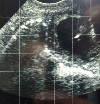 Figure 1. Ablation of the dominant follicle. The hyperechoic line of the needle can be seen in the lumen of the large follicle on the top right of the image.