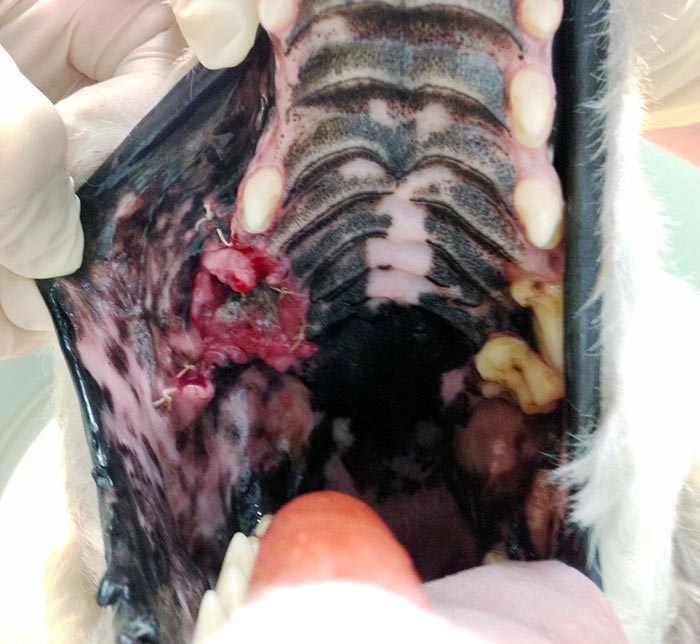 Previous biopsy of this oral squamous cell carcinoma extended the margins of the surgery, requiring a wider excision.