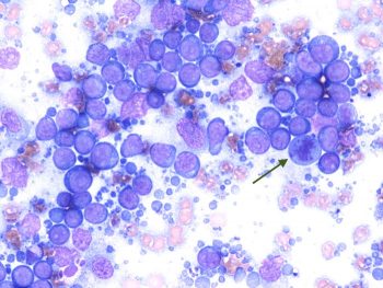 Cytology pictures from an aspirate of an enlarged prescapular lymph node in an eight-year-old, female dog.