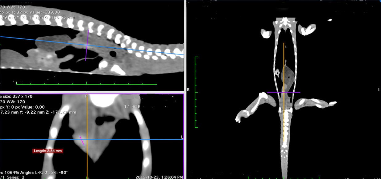 Figure 2. Reformatted CT images demonstrating right-sided nephrolith.