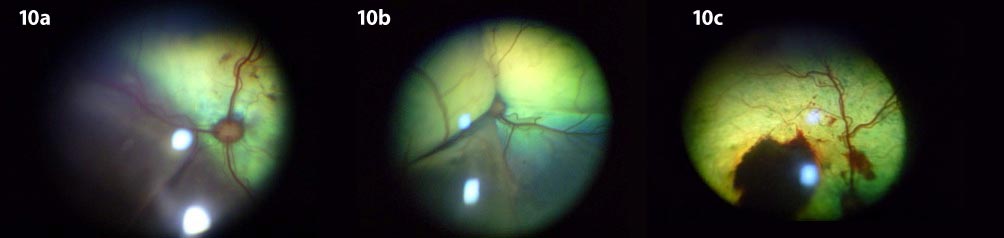 Figure 10. Characteristic appearance of complete bullous retinal detachment as seen through an indirect ophthalmoscope (10a and 10b). Intraretinal haemorrhages are noted in 10a. (10c) Retinal vascular tortuosity, intraretinal, subretinal and preretinal/vitreal haemorrhages – all associated with systemic hypertension. IMAGE: Frederic Goulle.