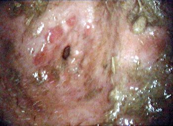 Figure 1. The pyloric antrum prior to washing demonstrating multifocal, moderate and flat and haemorrhagic lesions. These were lesions resistant to treatment, associated with clinical signs and took nine months to heal.