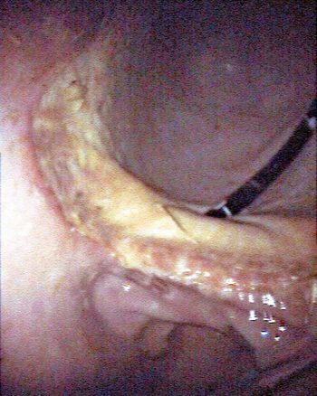 Figure 2. The position of pyloric antrum. At the top of the screen, the gastroscope is visible as it enters the stomach through the cardia. The lesser curvature is visible in the centre of the screen as a shelf, and beneath this is the pylorus and pyloric antrum. Some mild (grade two) squamous lesions are visible on the squamous mucosa overlying the lesser curvature. 