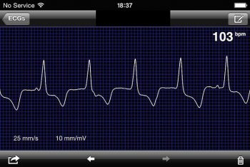 Figure 2. An example of ventricular tachycardia identified with a smartphone ECG rhythm strip.
