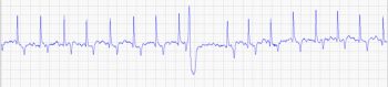 Figure 4a. Numerous ventricular premature depolarisations were detected before and after peak exercise in this horse that presented with poor race performance. Ambulatory ECG showed they were also present frequently at rest.