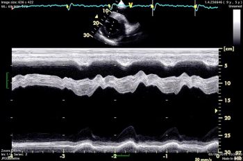 Figure 4b. Echocardiography showed mild ventricular dilation suggesting myocardial disease. Despite prolonged rest and anti-inflammatory medication, the horse continued to perform poorly.