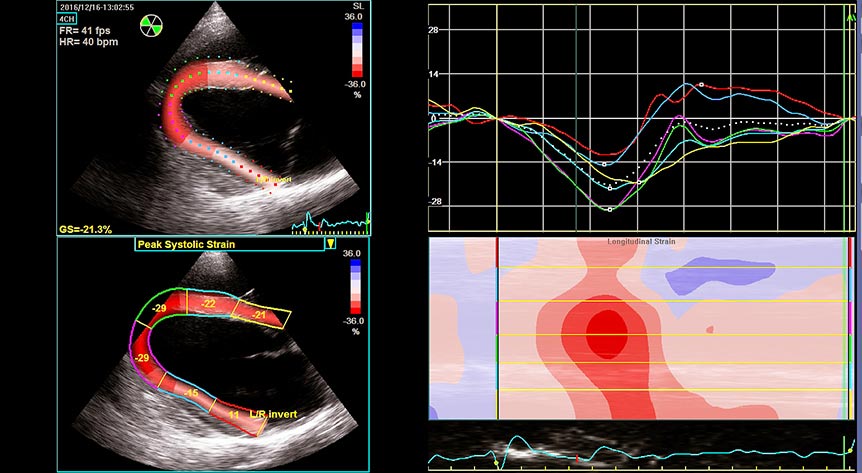 Figure 5. Speckle tracking echocardiography – in a longitudinal image of the left ventricle, offline analysis allows myocardial deformation (strain) to be documented in various regions. This is depicted as traces of longitudinal strain against time (upper right panel) and as colour-coded two-dimensional (left panels) and M-mode maps (lower right panel).