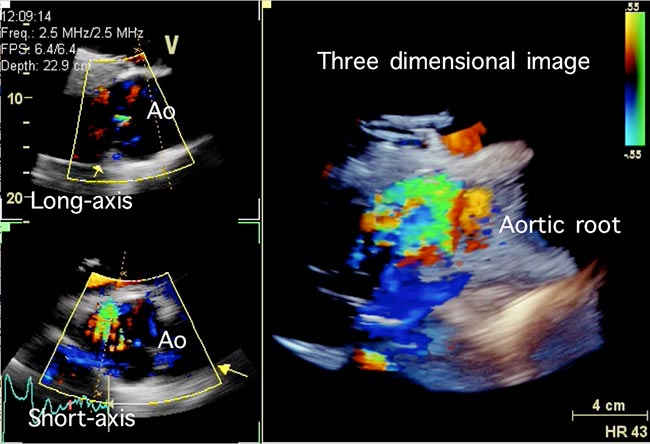 Figure 6b. The three-dimensional approach can also be used to examine colour Doppler data and provide a better appraisal of the volume and direction of regurgitant flow. In this example, a green jet can be seen as a green “C” shape just below the aortic valve. Ao = aorta.