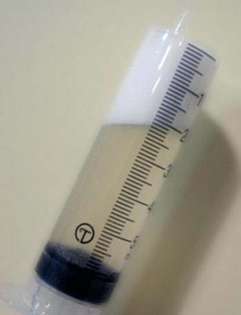 Figure 4. Collection of a bronchoalveolar lavage sample using a nasobronchial tube.