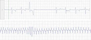 Figure 1. This is a resting (top) and exercising (bottom) ECG from an 18-year-old Warmblood gelding. This horse had a murmur consistent with mitral regurgitation and, on echocardiography, had an enlarged left atrium and ventricle. The horse had one ventricular premature depolarisation at rest, but had evidence of ventricular tachycardia at peak exercise. Note how regular this rhythm looks (and would sound). This horse was retired from ridden work and found dead in the field three years after this evaluation. 