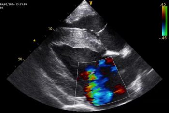 Figure 2. This is an echocardiogram obtained in a 10-year-old polo pony, where a grade V/VI pansystolic harsh plateau-shaped murmur point of maximal intensity left intercostal 5 had been found, having not been present four weeks previously. It is a right-sided parasternal view of the left ventricle, demonstrating severe mitral regurgitation secondary to a rupture of a minor chordae tendineae. With monitoring, this horse is still in work.