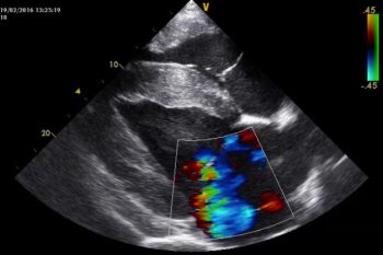 Figure 2. This is an echocardiogram obtained in a 10-year-old polo pony, where a grade V/VI pansystolic harsh plateau-shaped murmur point of maximal intensity left intercostal 5 had been found, having not been present four weeks previously. It is a right-sided parasternal view of the left ventricle, demonstrating severe mitral regurgitation secondary to a rupture of a minor chordae tendineae. With monitoring, this horse is still in work.